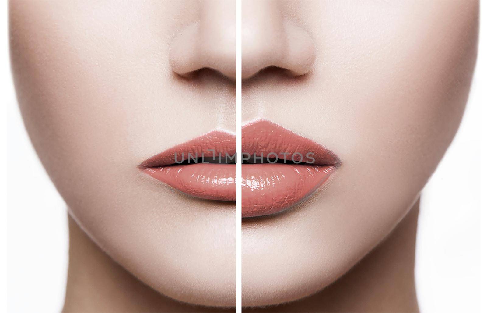 Closeup of female lips before and after augmentation procedure. by Khosro1