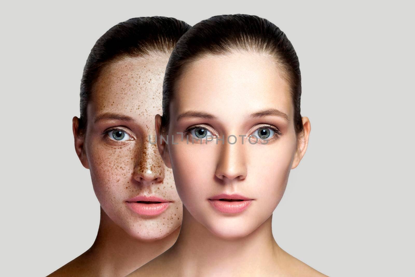 healing and removing freckles medical concept. looking at camera. by Khosro1