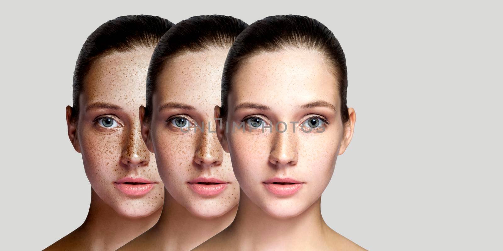 Step by step concept of healing and removing freckles. Closeup portrait of beautiful brunette woman after laser treatment on face looking at camera. indoor studio shot, isolated on gray background.