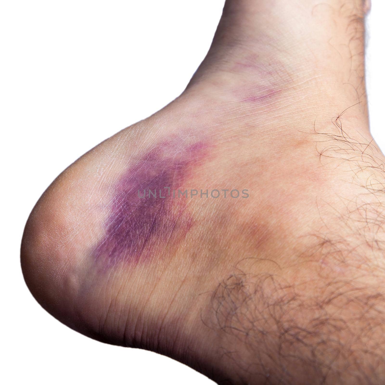 Bruised ankle after tripping over and twisting on right hairy foot on blue background..