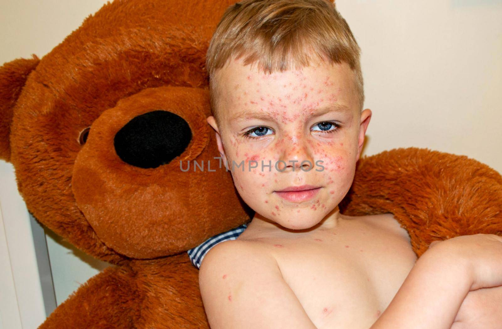 Natural vaccination. Contagious disease. Sick boy chickenpox with toy bear. Varicella virus or Chickenpox bubble rash on child body and face. High quality photo