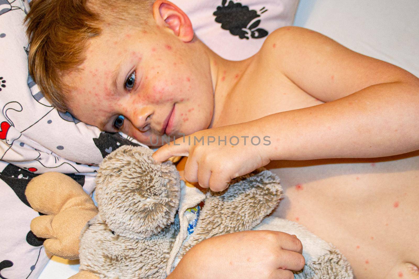 Natural vaccination. Contagious disease. Sick child with chickenpox. Varicella virus or Chickenpox bubble rash on child body and face. High quality photo