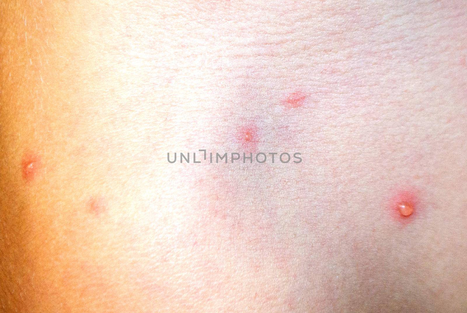 Natural vaccination. Contagious disease. Sick child with chickenpox. Varicella virus or Chickenpox bubble rash on child body and face. High quality photo