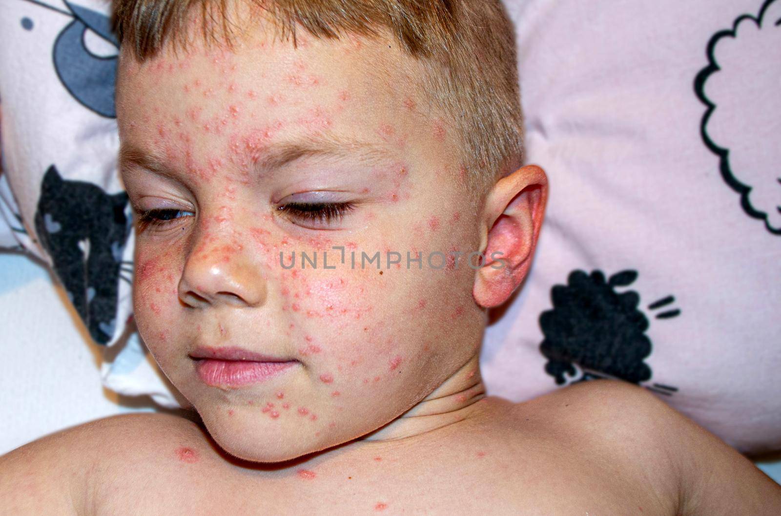 Natural vaccination. Contagious disease. Sick child with chickenpox. Varicella virus or Chickenpox bubble rash on child body and face. High quality photo