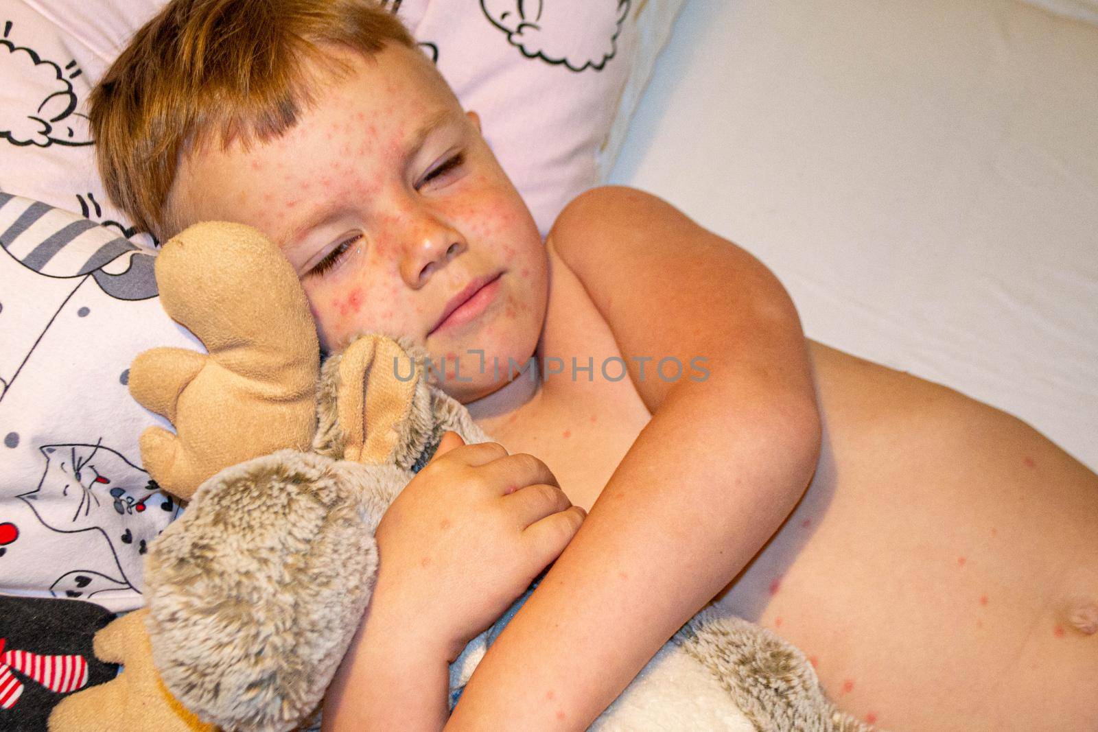 Natural vaccination. Contagious disease. Sick child with chickenpox. Varicella virus or Chickenpox bubble rash on child body and face. High quality photo