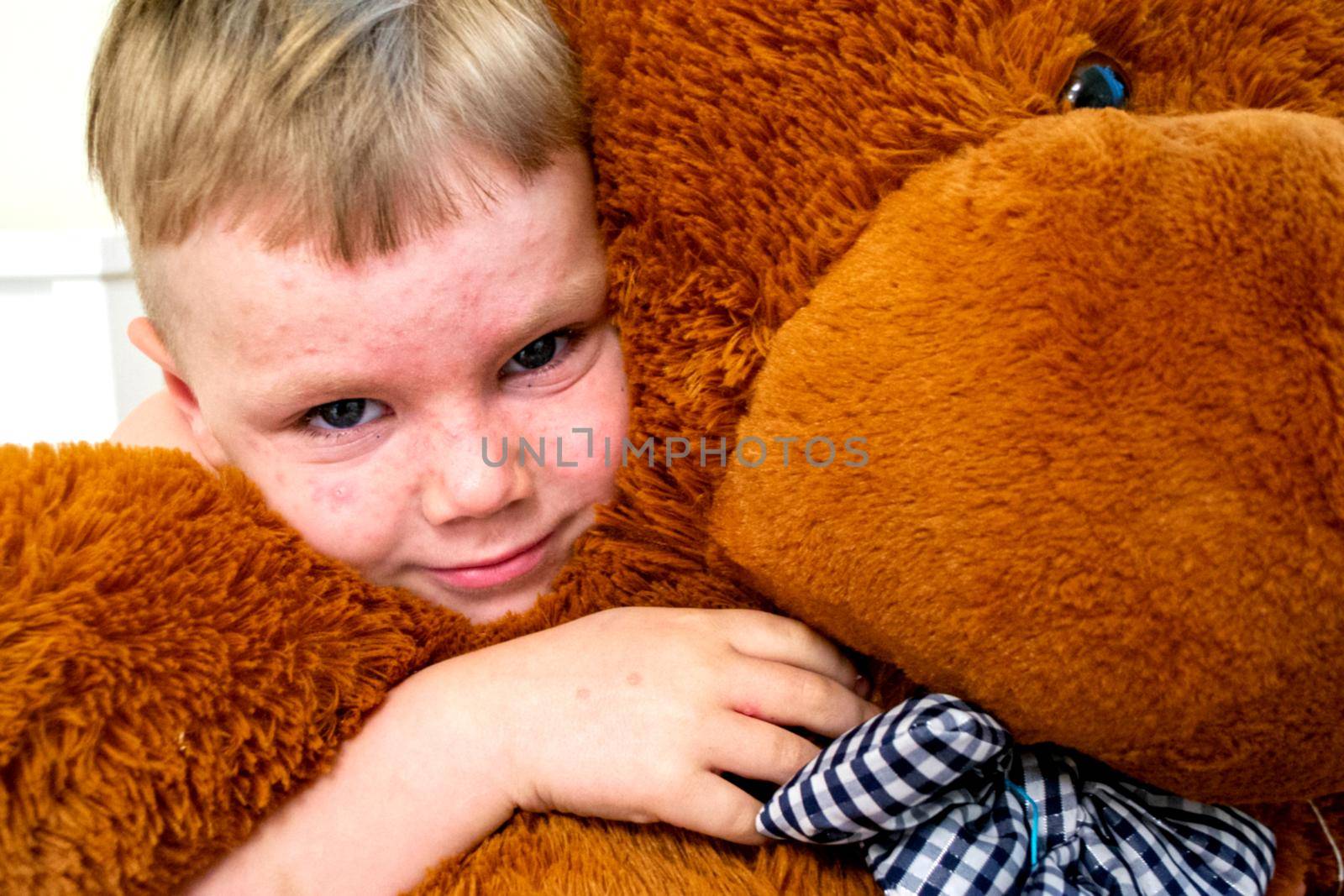 Natural vaccination. Contagious disease. Sick boy chickenpox with toy bear. Varicella virus or Chickenpox bubble rash on child body and face. High quality photo