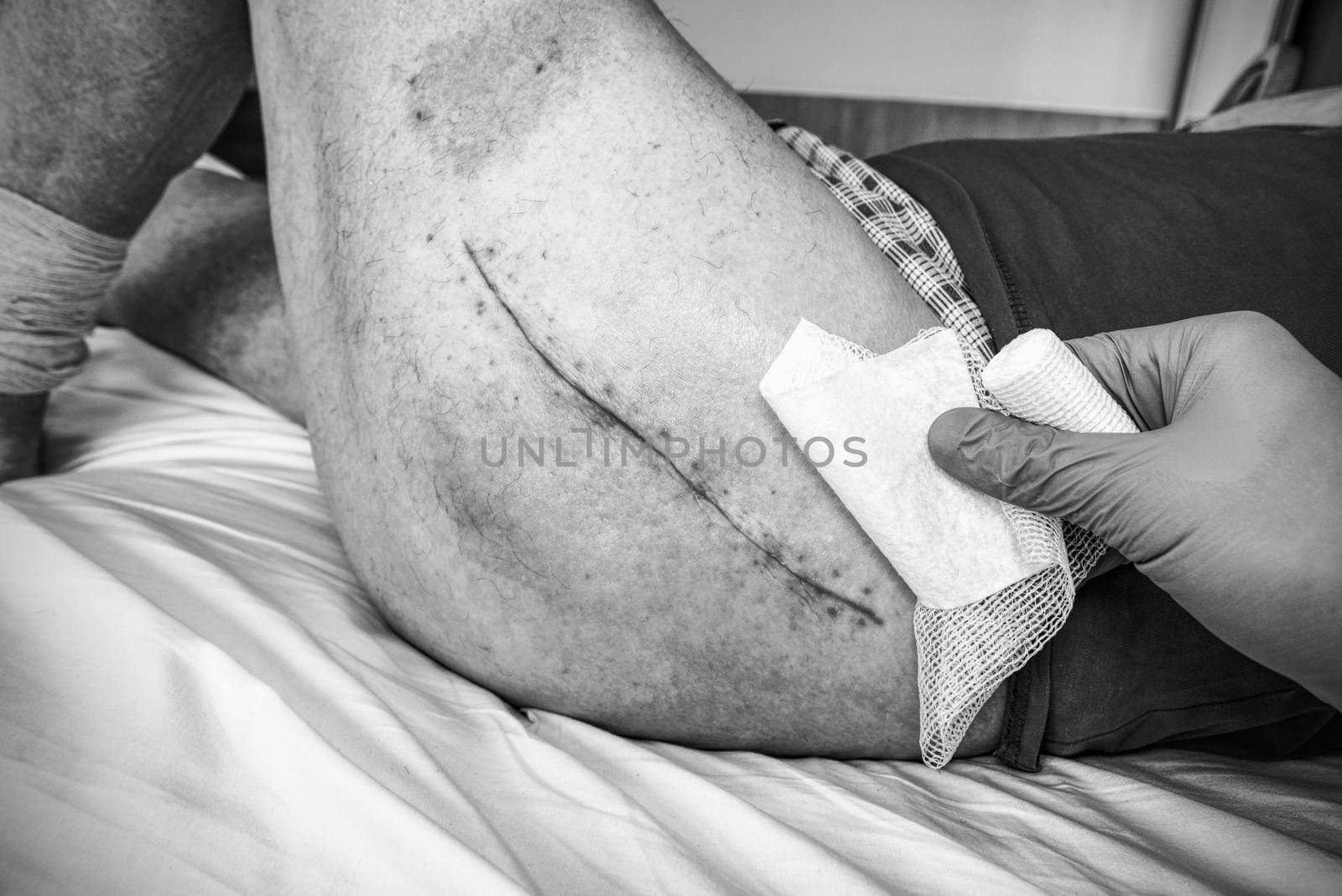 Old Human leg with postoperative scar of hip joint surgery. Selective focus of male body. by rdonar2