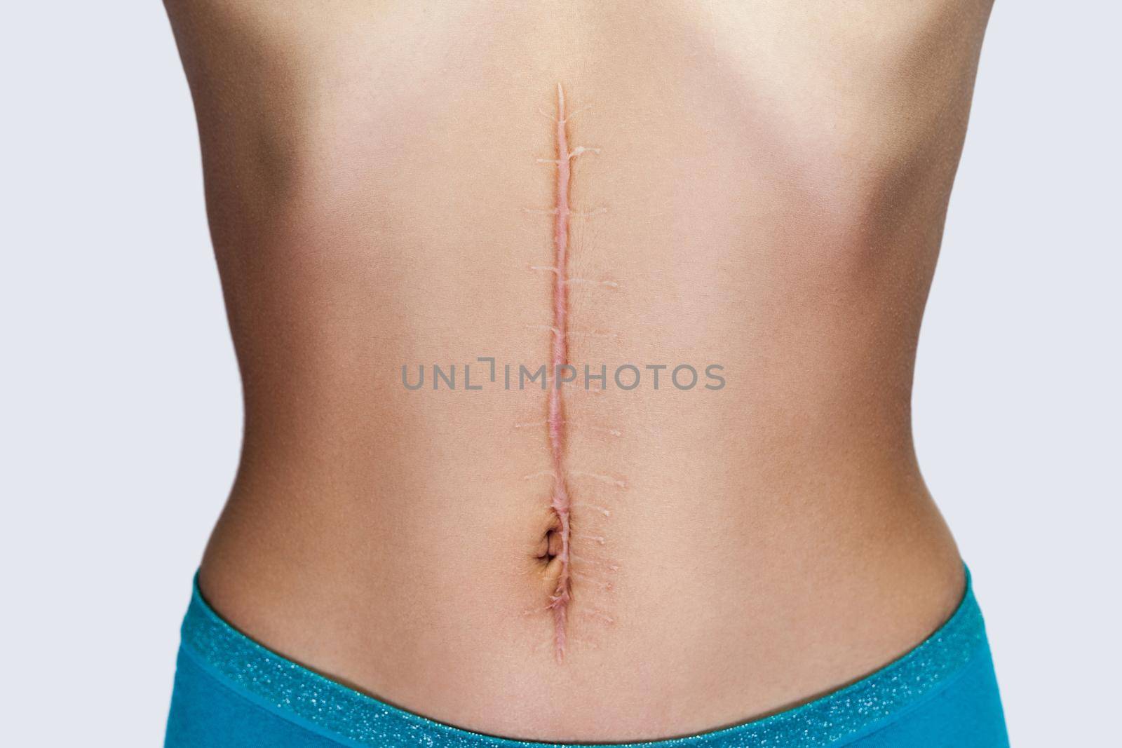 Closeup of young woman with large scar after surgery on abdomen. by Khosro1