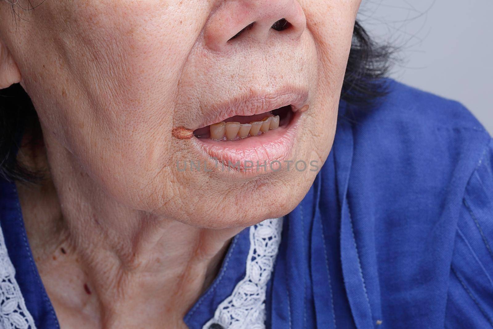 Angular cheilitis is a type of common inflammation of the lips by toa55