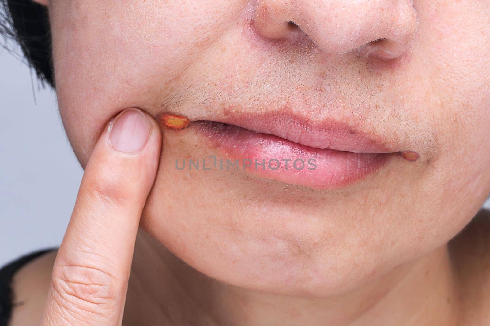 Angular cheilitis is a type of common inflammation of the lips