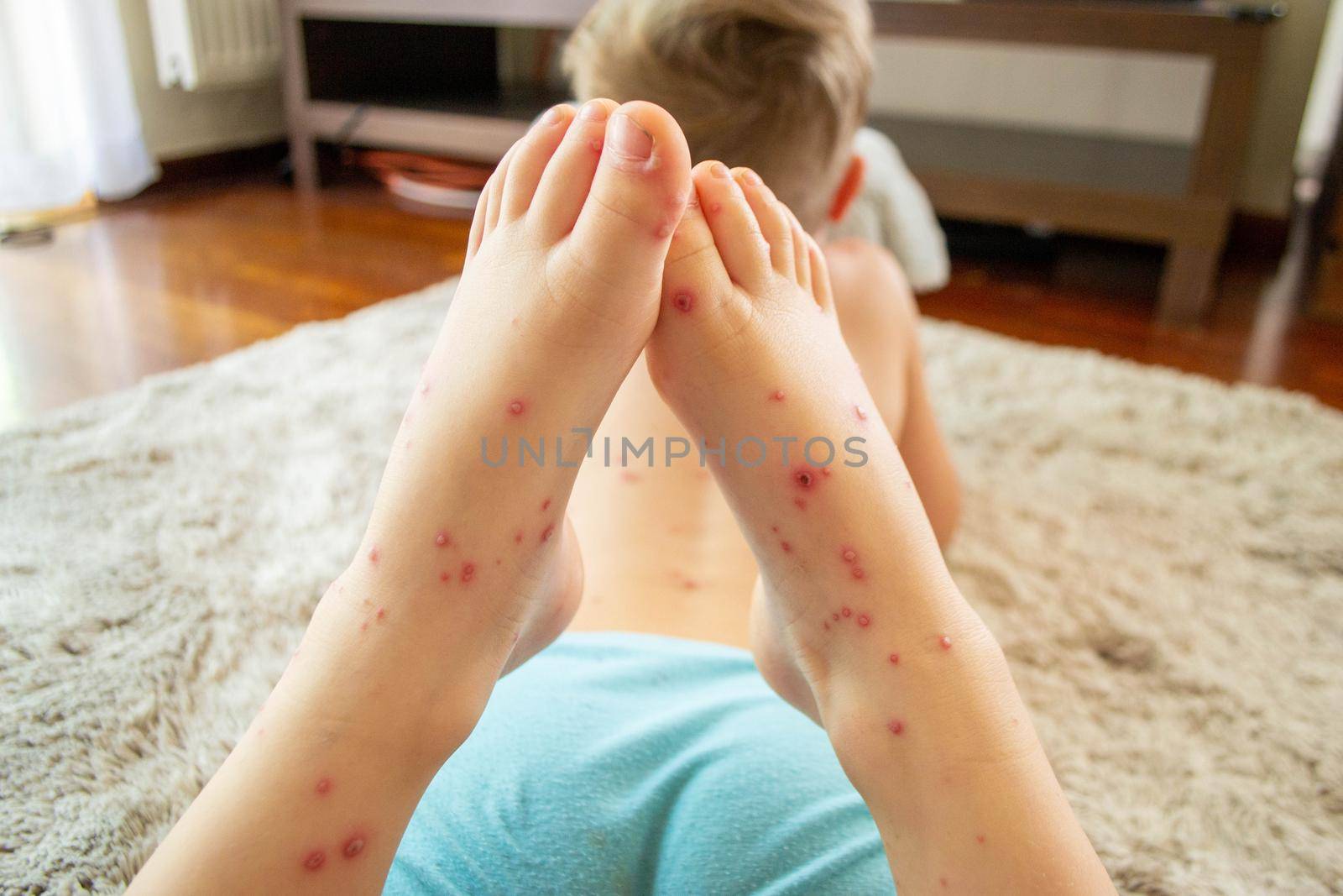 Natural vaccination. Contagious disease. Sick child with chickenpox. Varicella virus or Chickenpox bubble rash on child body and face. High quality photo