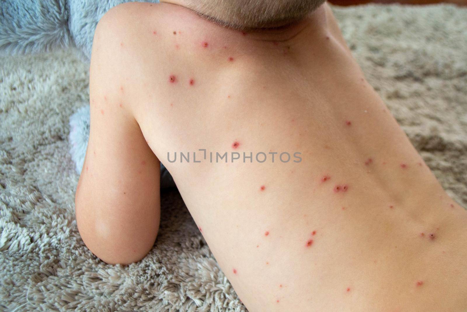 Natural vaccination. Contagious disease. Sick child with chickenpox. Varicella virus or Chickenpox bubble rash on child body and face. High quality photo