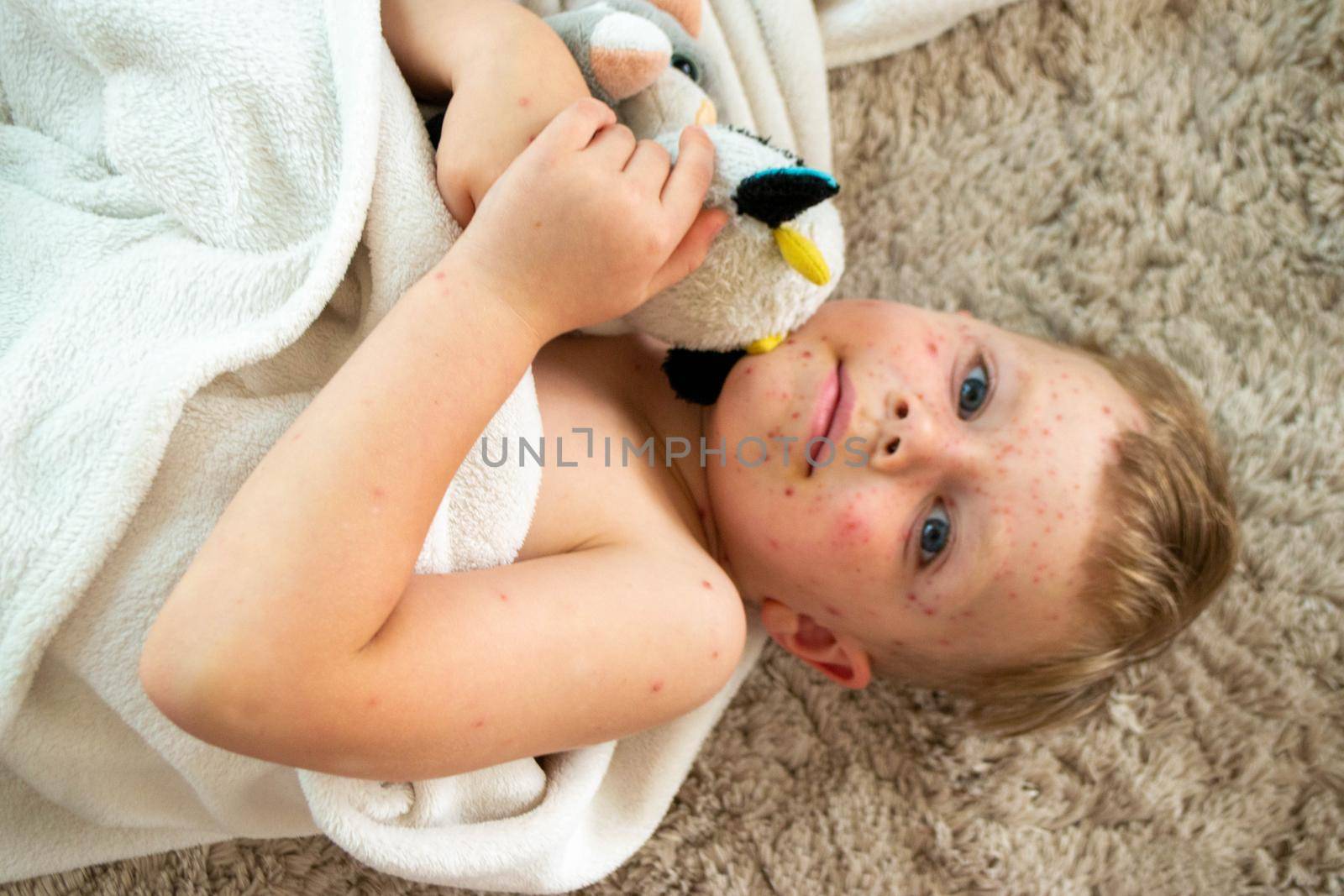 Natural vaccination. Contagious disease. Sick child with chickenpox. Varicella virus or Chickenpox bubble rash on child body and face. High quality photo