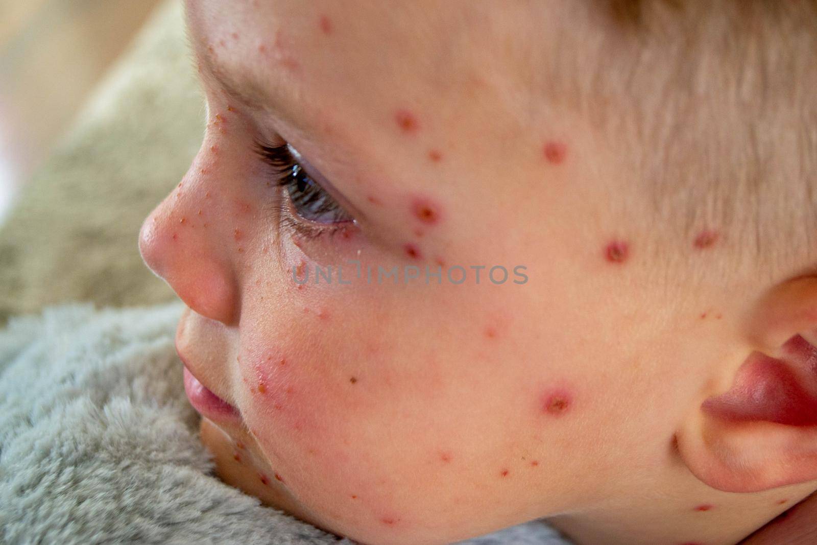 Natural vaccination. Contagious disease. Sick child with chickenpox. Varicella virus or Chickenpox bubble rash on child body and face. High quality photo