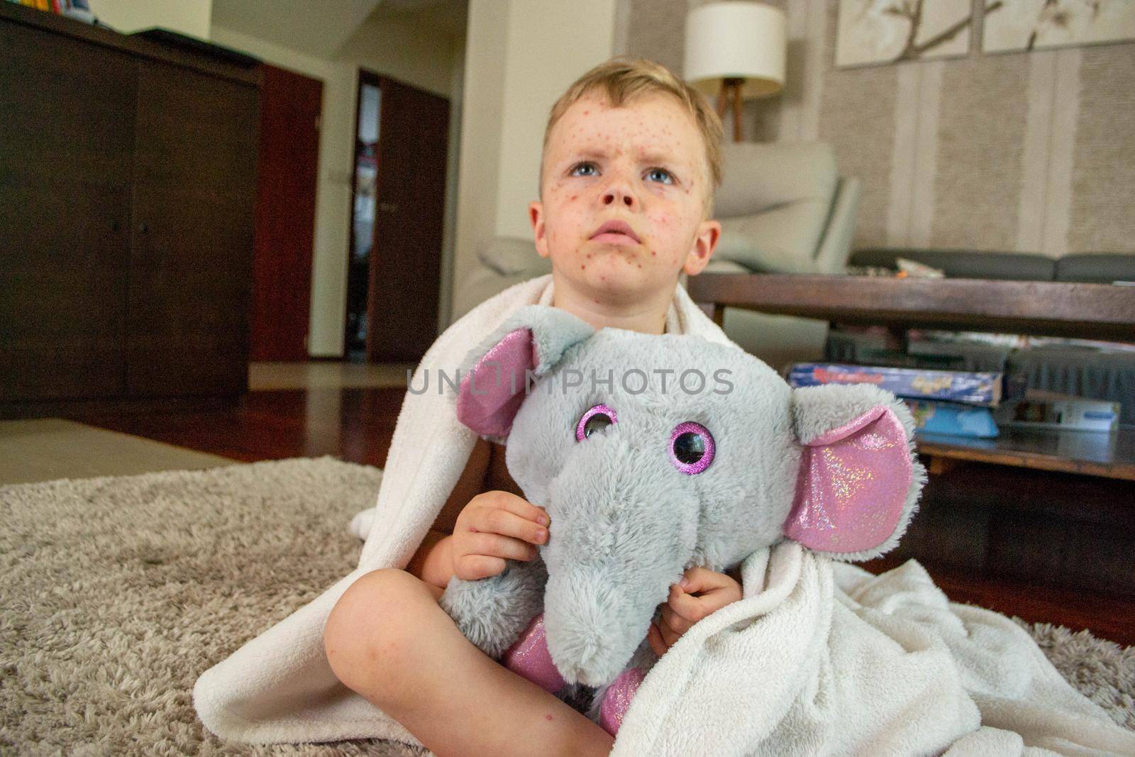 Natural vaccination. Contagious disease. Sick child with chickenpox. Varicella virus or Chickenpox bubble rash on child body and face. High quality photo