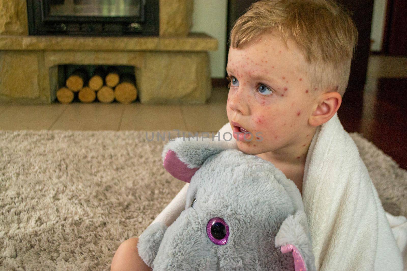 Natural vaccination. Contagious disease. Sick child with chickenpox. Varicella virus or Chickenpox bubble rash on child body and face. High quality photo