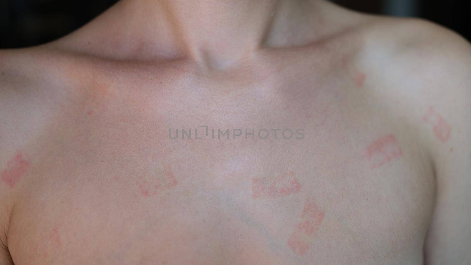 Red itchy patch rash on woman skin closeup by kuprevich