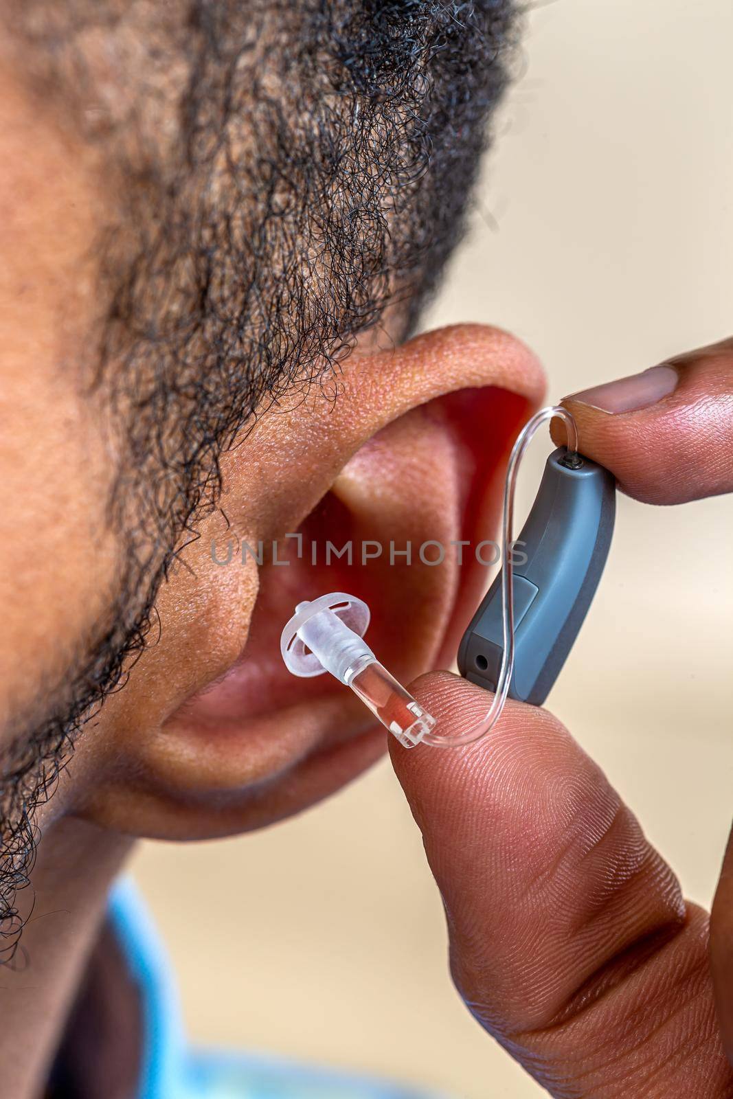 Close-up of the placement of the prosthesis in the ear of a young man.