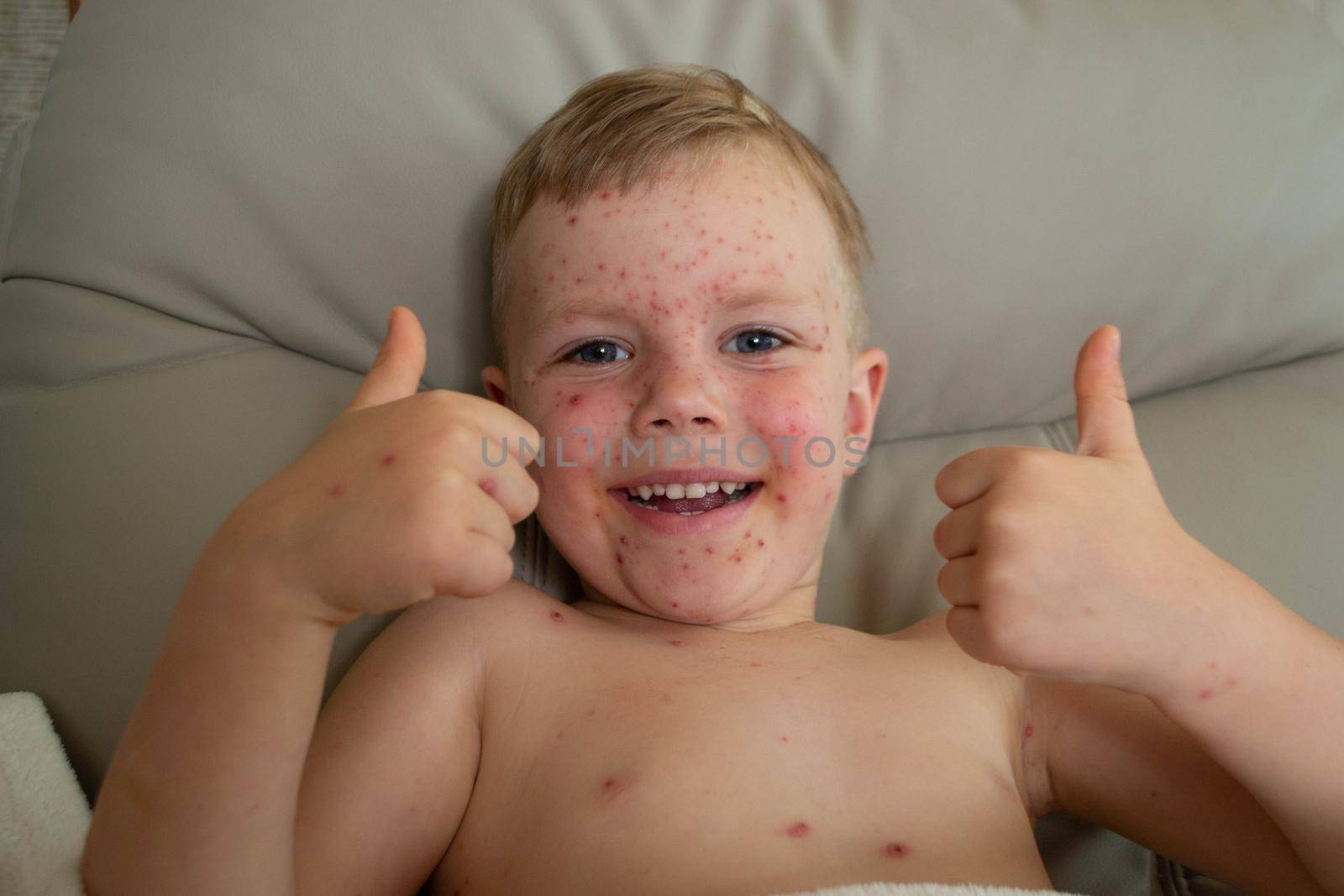 Natural vaccination. Contagious disease. Sick child with chickenpox. Varicella virus or Chickenpox bubble rash on child body and face. High quality photo