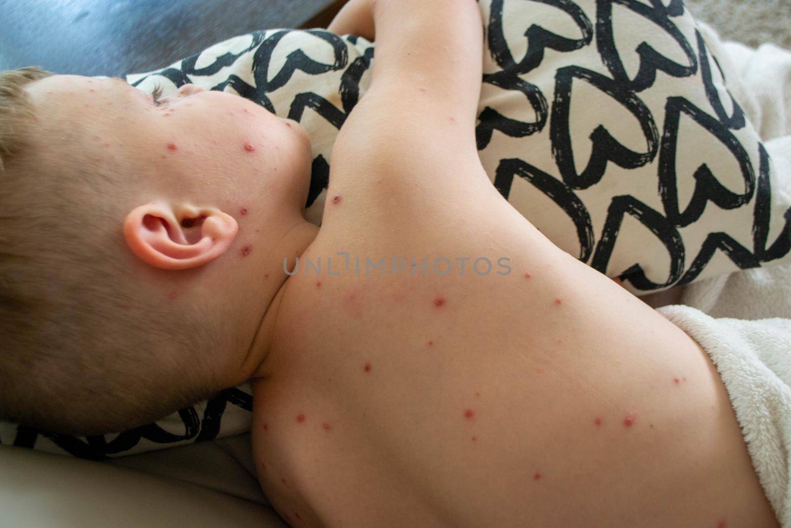 Natural vaccination. Contagious disease. Sick child with chickenpox. Varicella virus or Chickenpox bubble rash on child body and face. High quality photo