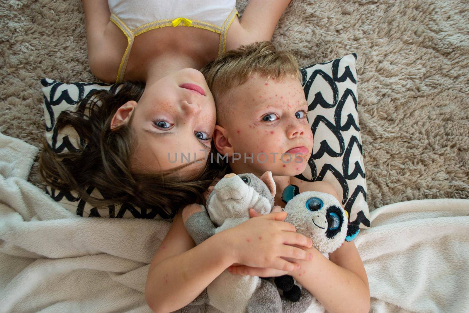 Natural vaccination. Contagious disease. Sick child with chickenpox. Varicella virus or Chickenpox bubble rash on child body and face. High quality photo