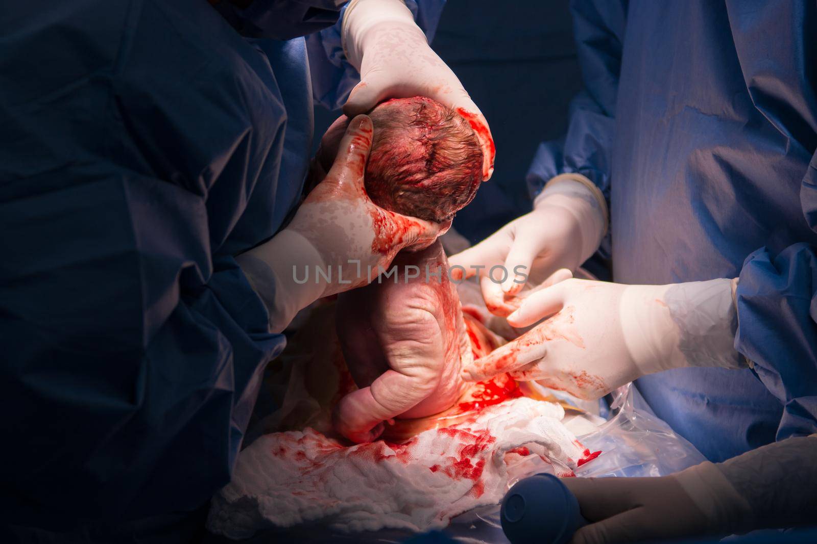 Cesarean section. The operation is in process. The child closeup