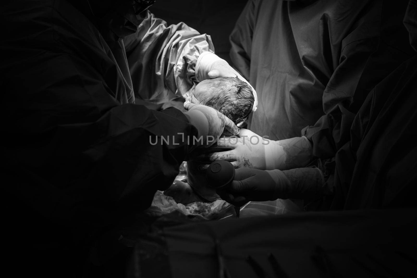 Cesarean section. The operation is in process. The child closeup