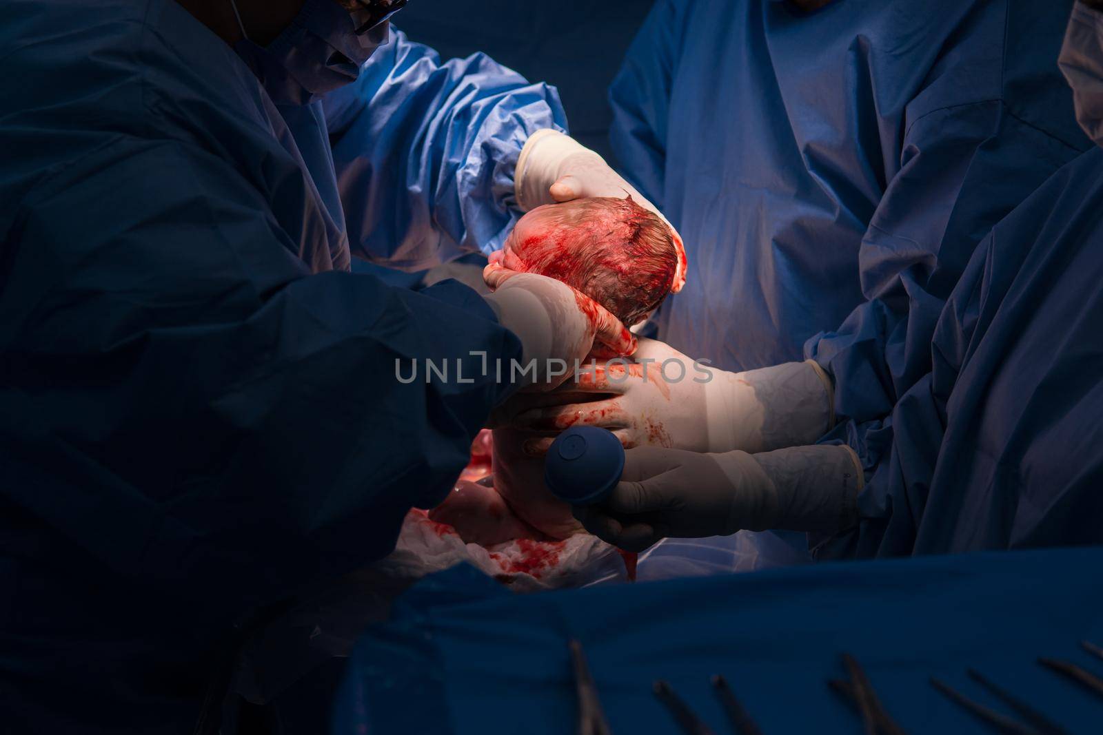 Cesarean section. The operation is in process. The child closeup