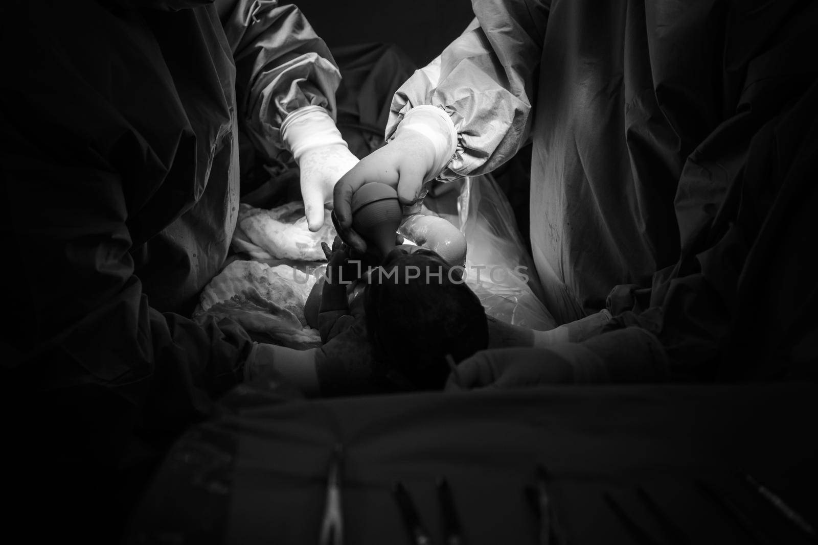 Cesarean section. The operation is in process. The child closeup