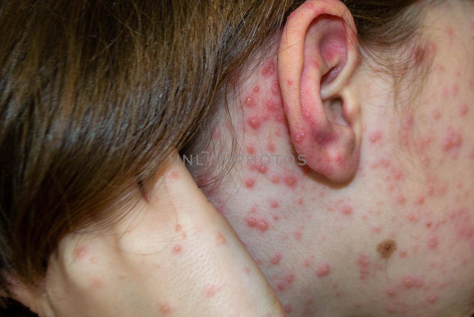 Natural vaccination. Contagious disease. Sick child with chickenpox. Varicella virus or Chickenpox bubble rash on child body and face. High quality photo