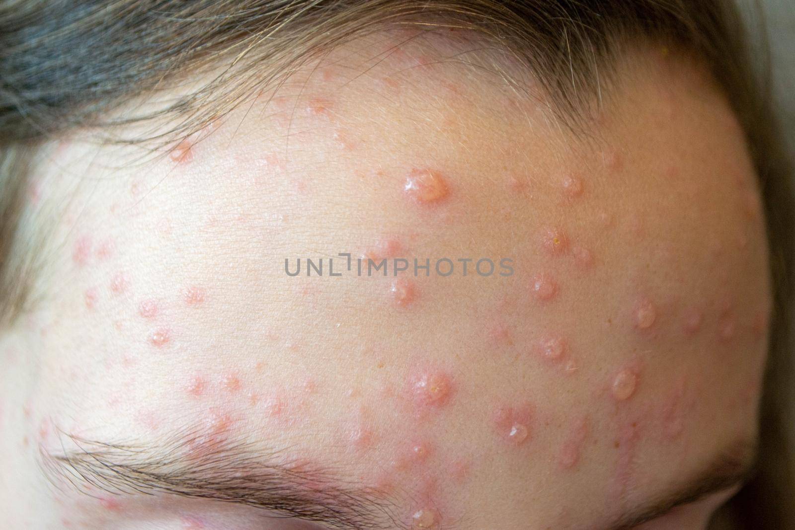 Natural vaccination. Contagious disease. Sick child with chickenpox. Varicella virus or Chickenpox bubble rash on child body and face. High quality photo