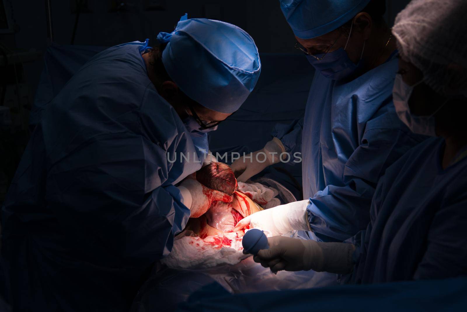 Cesarean section. The operation is in process. The child closeup