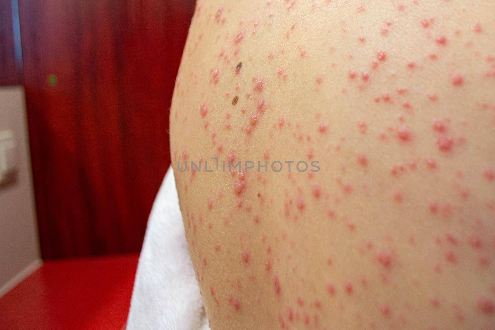 Natural vaccination. Contagious disease. Sick child with chickenpox. Varicella virus or Chickenpox bubble rash on child body and face. High quality photo