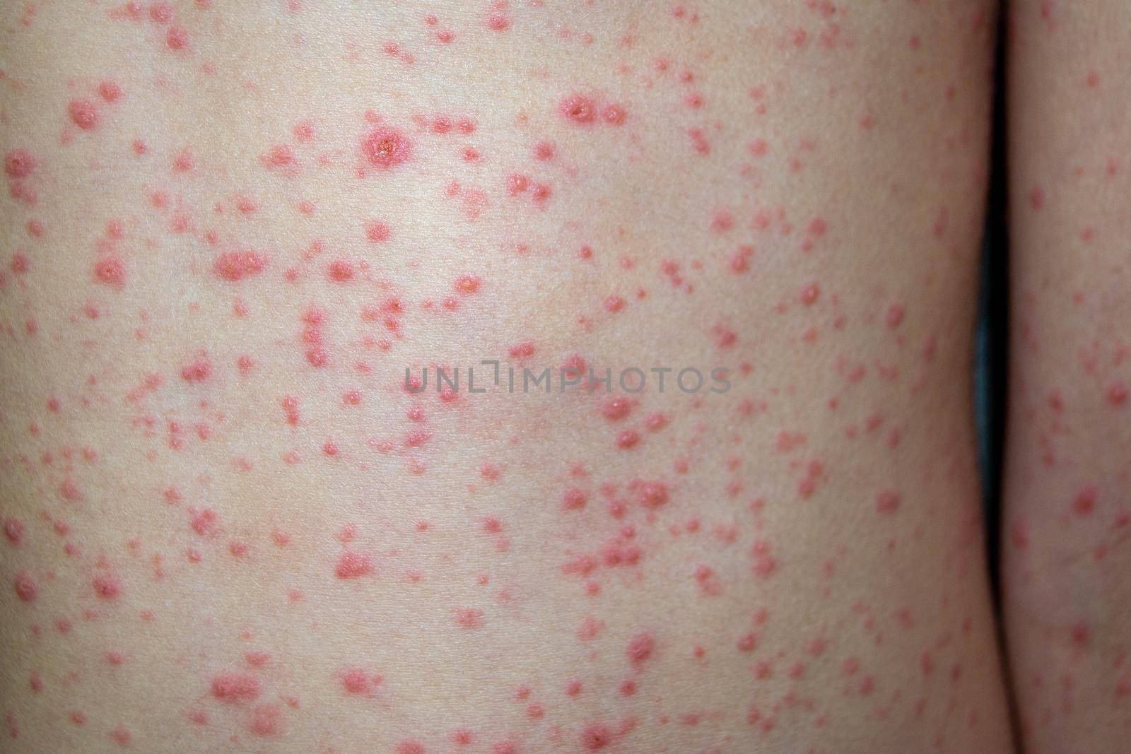 Natural vaccination. Contagious disease. Sick child with chickenpox. Varicella virus or Chickenpox bubble rash on child body and face. High quality photo