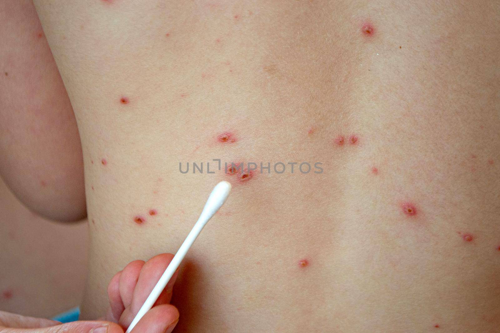 Natural vaccination. Contagious disease. Sick child with chickenpox. Varicella virus or Chickenpox bubble rash on child body and face. High quality photo