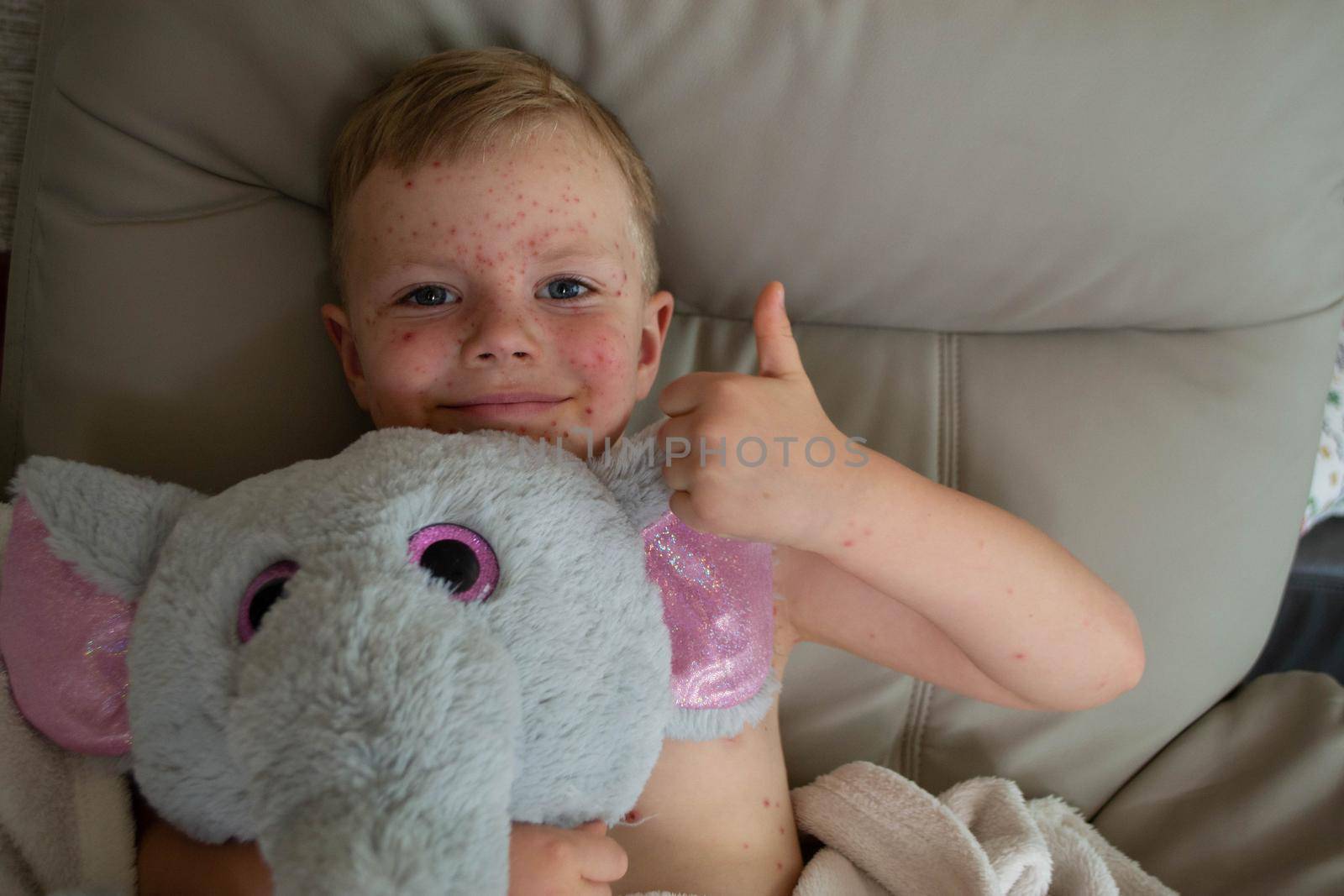 Natural vaccination. Contagious disease. Sick child with chickenpox. Varicella virus or Chickenpox bubble rash on child body and face. High quality photo