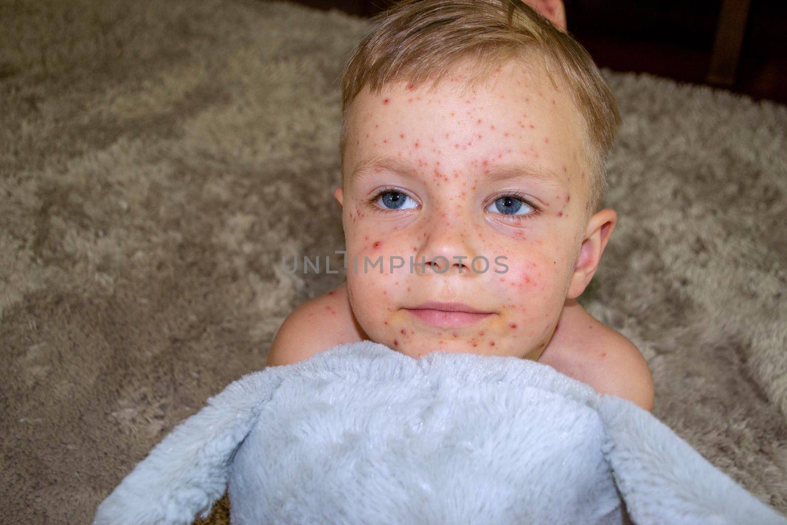 Natural vaccination. Contagious disease. Sick child with chickenpox. Varicella virus or Chickenpox bubble rash on child body and face. High quality photo