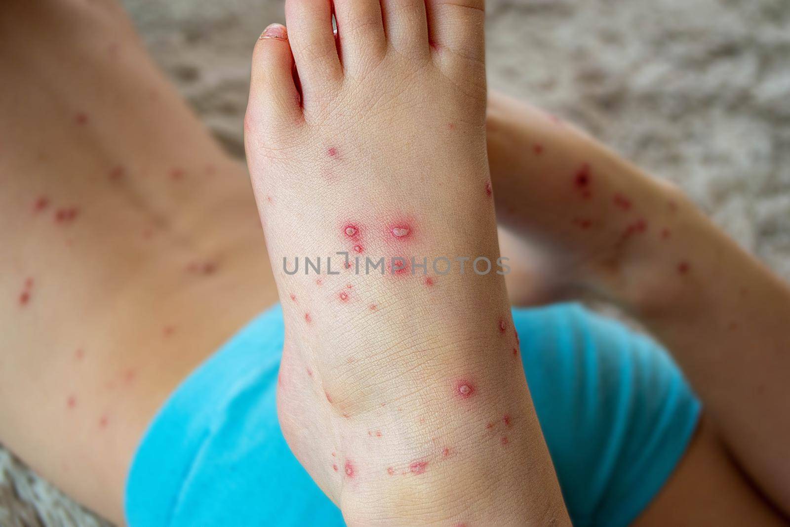 Natural vaccination. Contagious disease. Sick child with chickenpox. Varicella virus or Chickenpox bubble rash on child body and face. High quality photo