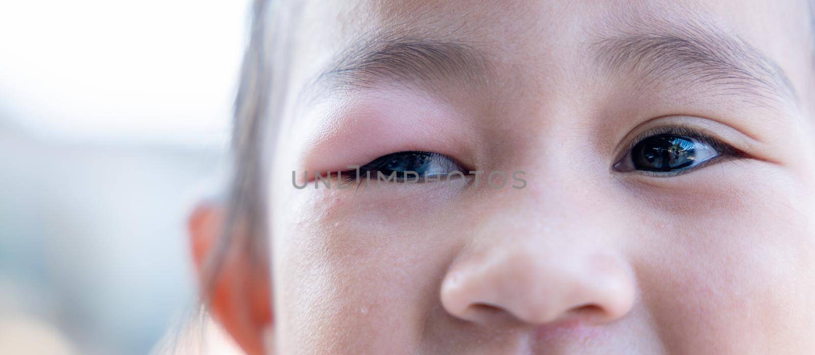 Stye Eye diseases. Closed Asian kid little girl eye with sty, eyelid abscess ophthalmic hordeolum