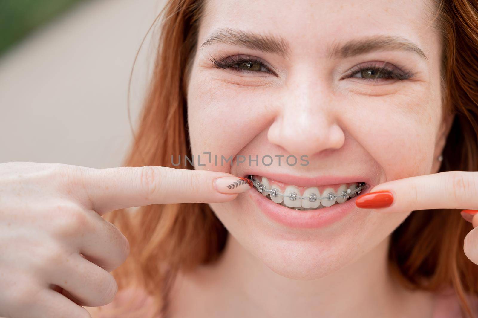 Young red-haired woman with braces on her teeth point to a smile outdoors in summer.