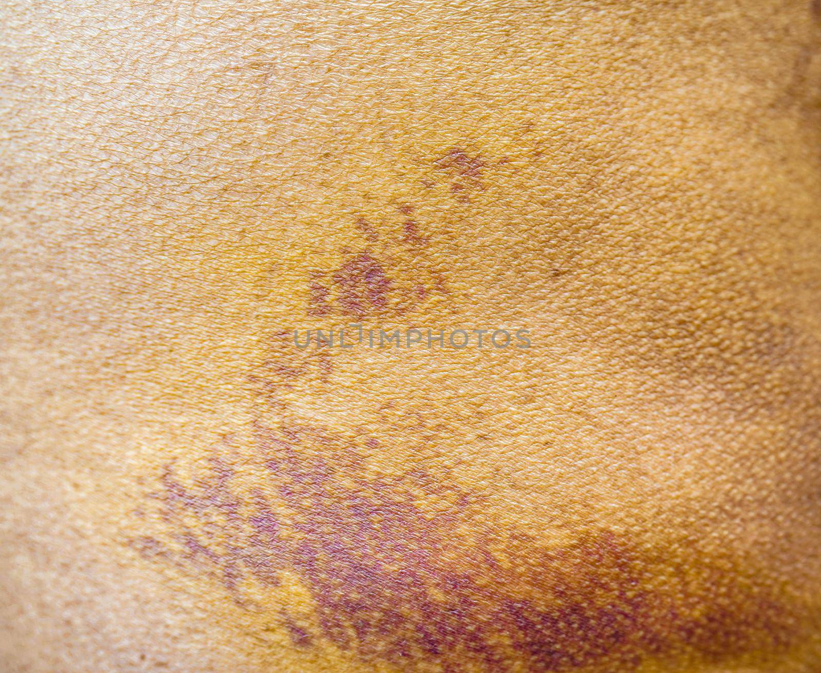Bruise on the buttock skin injury from accident at home.