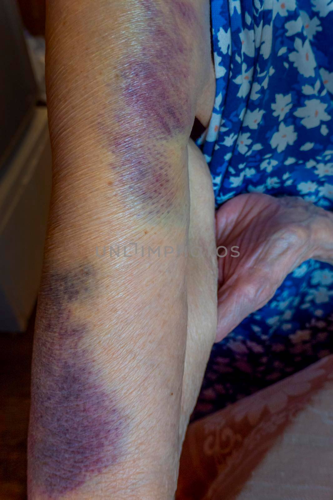 A bruise after an unsuccessful fall on the hands of an elderly man. Old age. wrinkled skin. an elderly woman with bruises on her hands is playing cards, keeping score