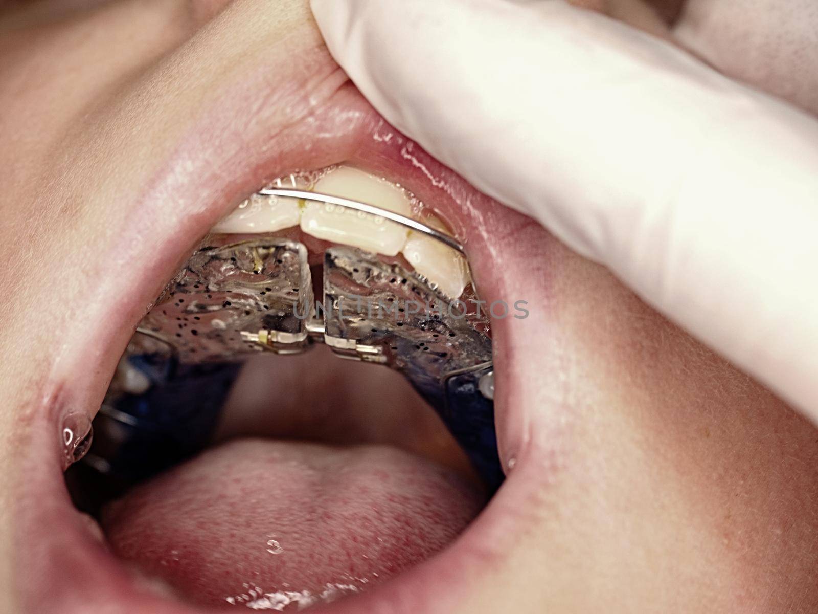 Orthodontist inserting ligatures into children mouth, orthodontic appliance. Boy holds open mouth