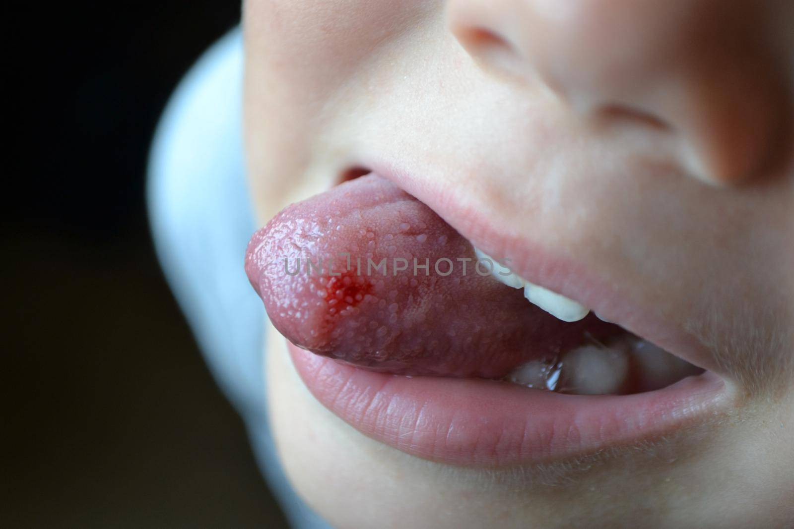 Child's bitten tongue. Close-up of lips, tongue, protrusion of blood