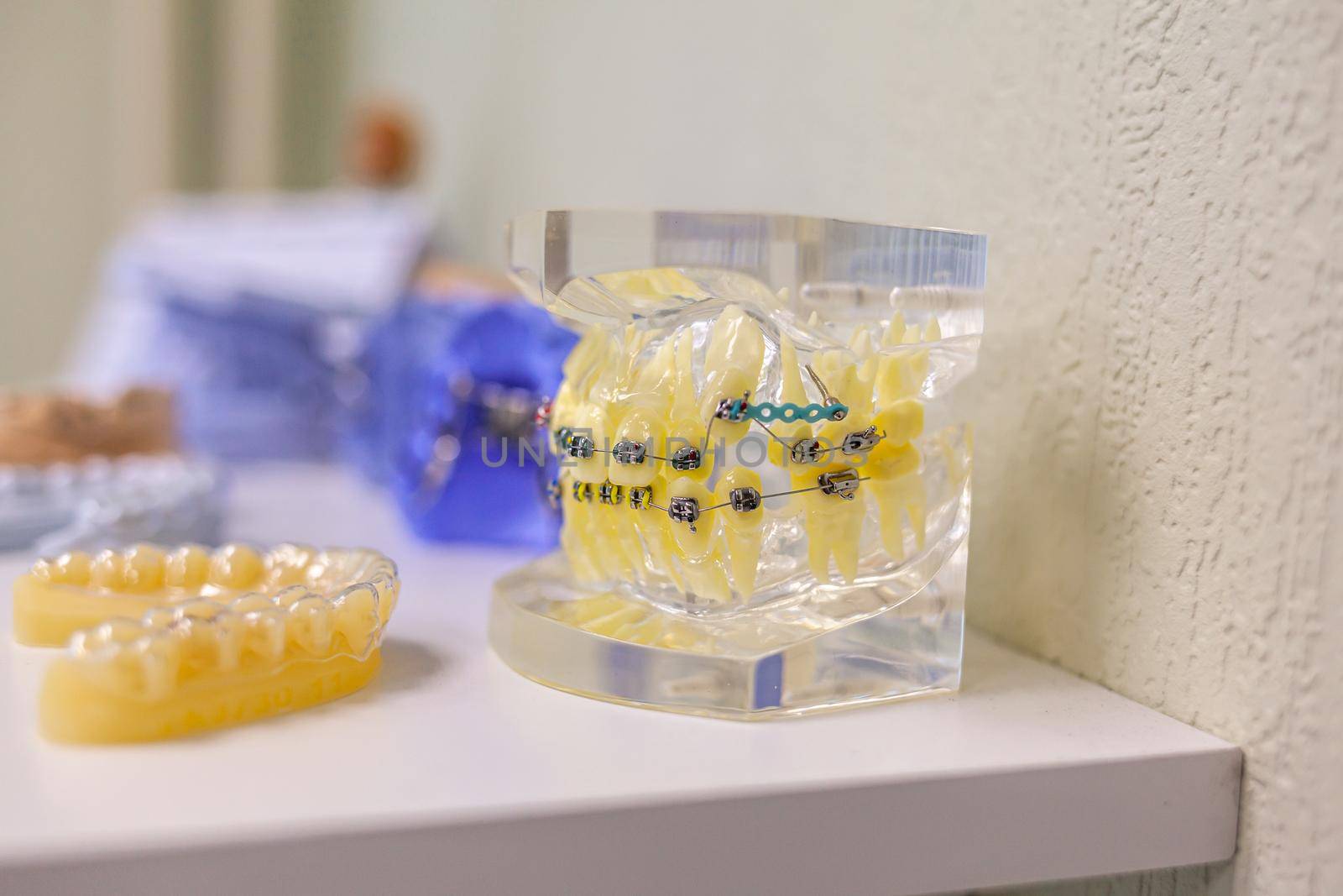 Dental model of the tooth jaw with metal braces and wire by AnatoliiFoto