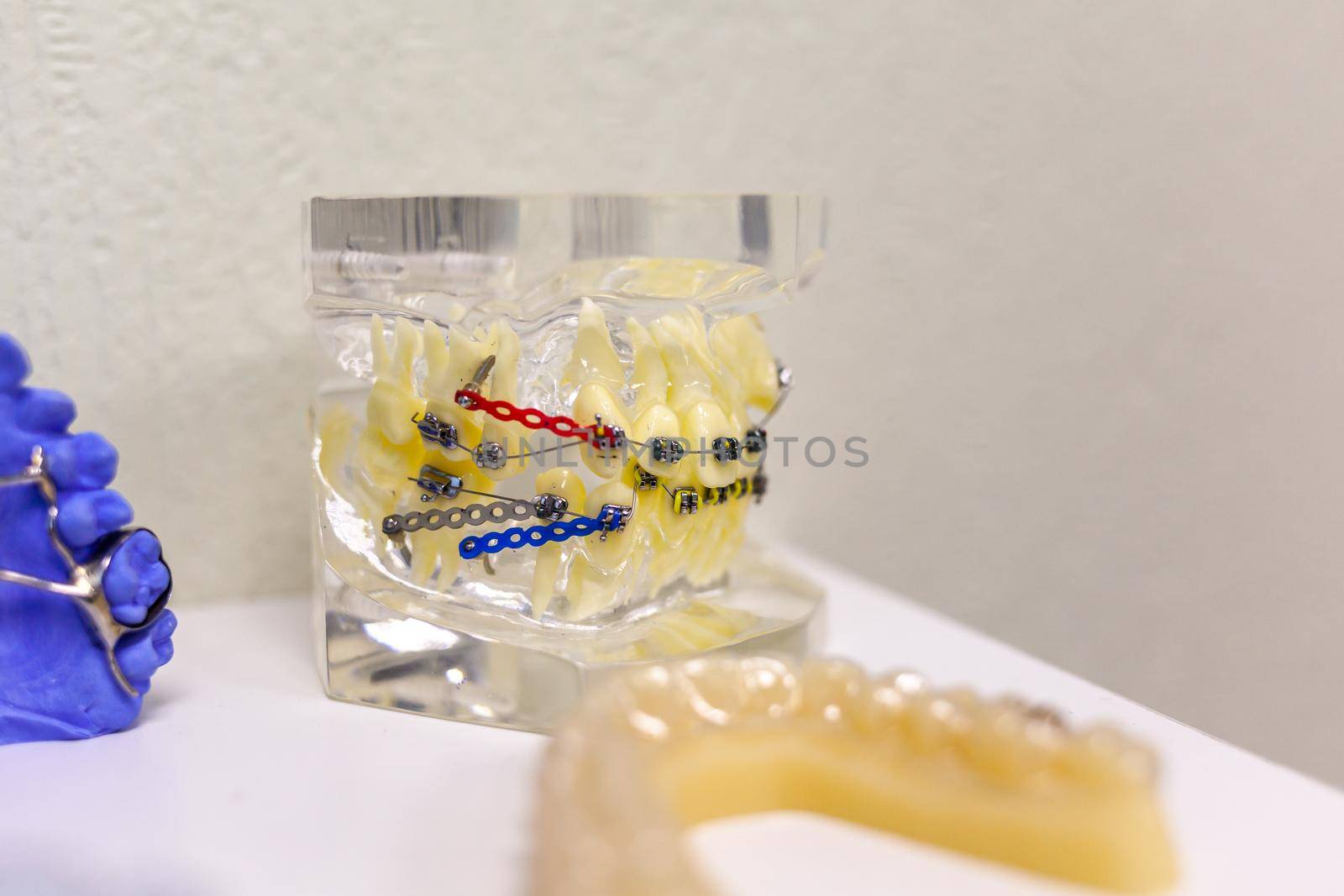 Dental model of the tooth jaw with metal braces and wire in a natural form. Model of installation of braces on teeth. Dental treatment.