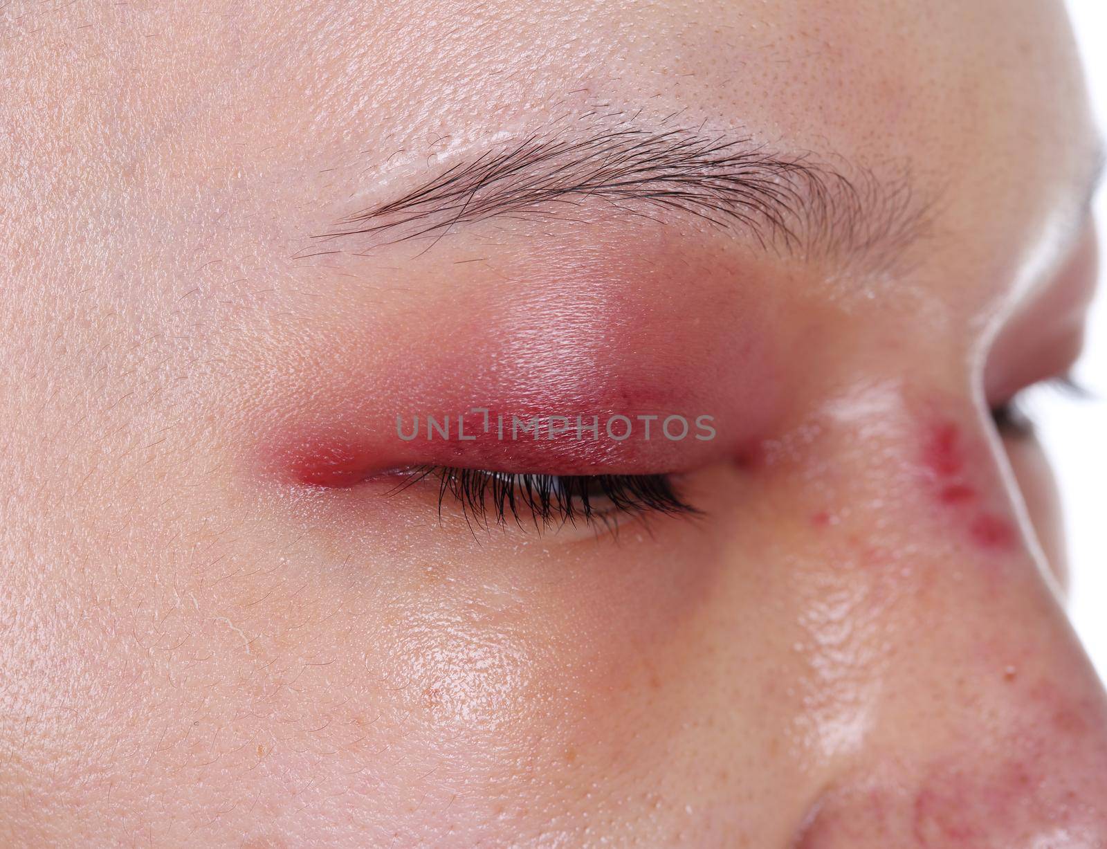 close-up of upper eye lid swell after nose job plastic surgery