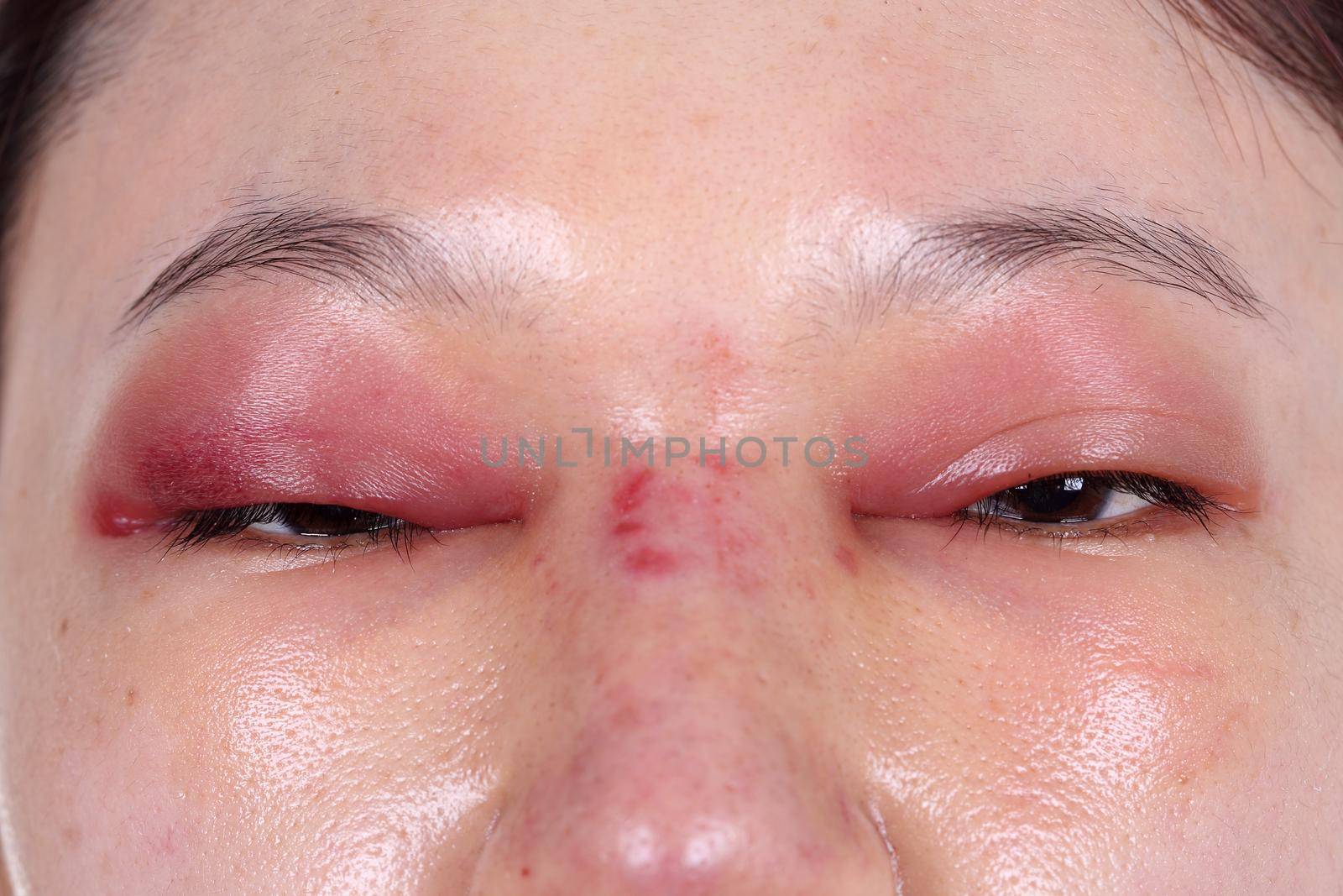 upper eye lid and nose swell after nose job plastic surgery