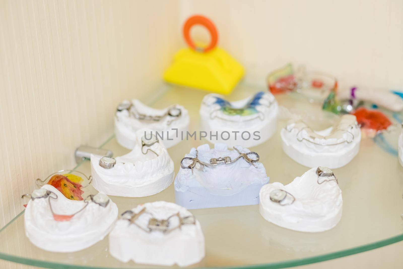 models of Dental plate to align deformed teeth. unremovable orthodontic plate on a dental model of gypsum.Children orthodontic plate with a screw, modern made of colored plastic by YuliaYaspe1979