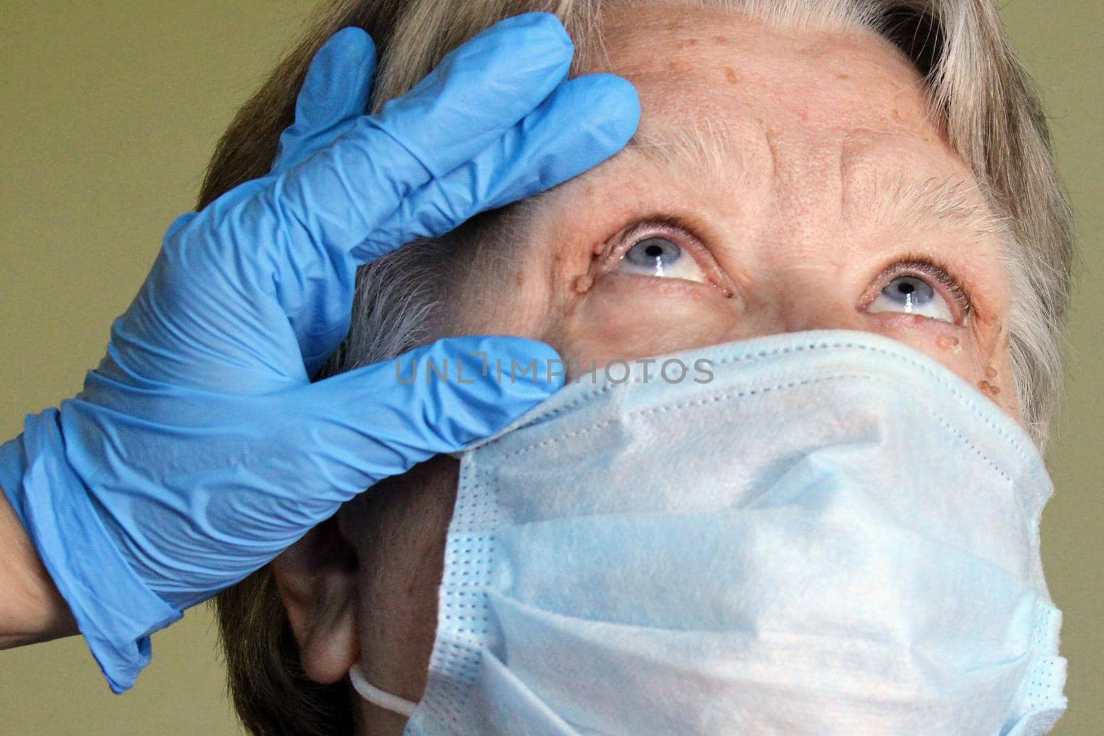 The doctor examines the eyes of an elderly woman with papillomas. At the doctor's appointment..
